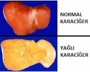 KARACİĞER YAĞLANMASI